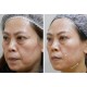Liposonix + Hifu facial y corporal - (rejuvenecimiento y adelgazamiento)