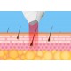 DEPILACION LASER DIODO 808 NM (755 + 808 + 1064 NM) CON RADIOFRECUENCIA BIPOLAR (depilación sin dolor)